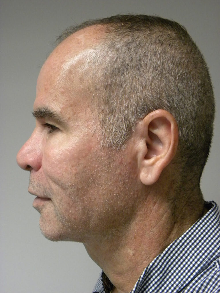 Neck Lift Before and After Pictures Miami, FL