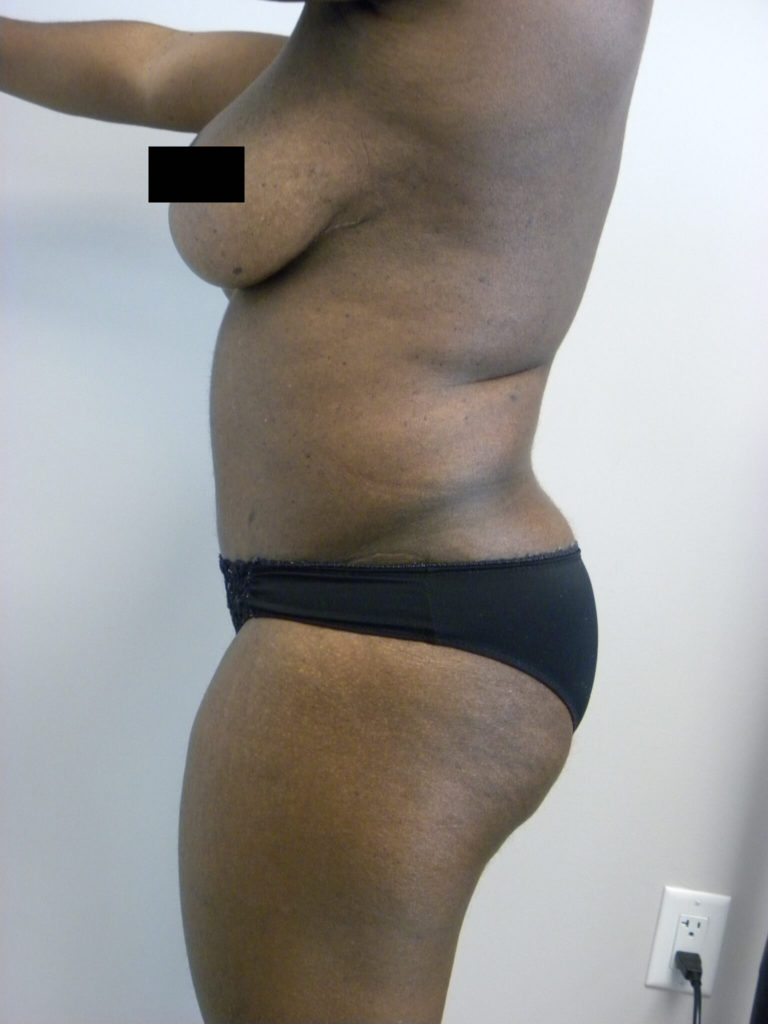 Tummy Tuck Before and After Pictures Miami, FL