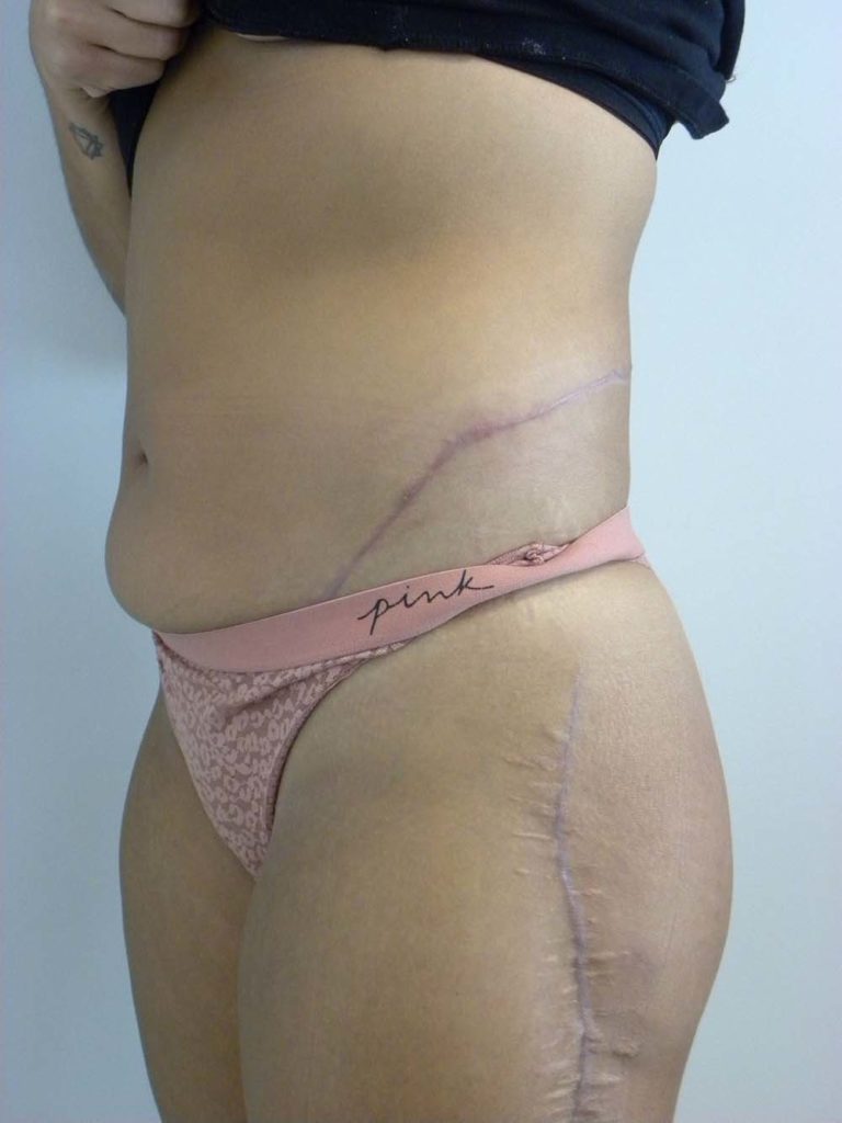 Scar Revision Before and After Pitcures in Miami, FL