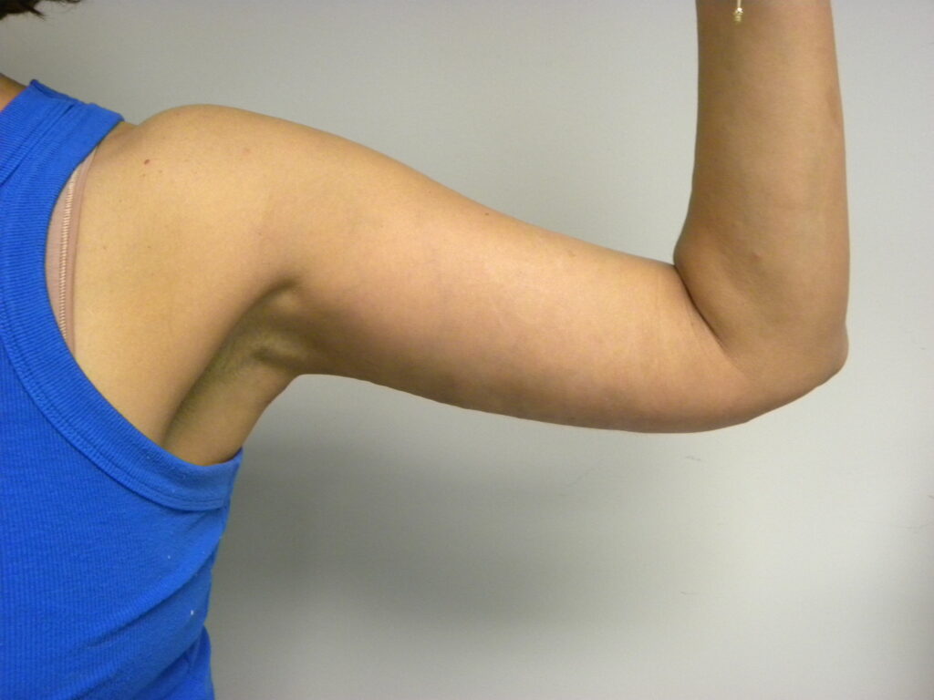 ARM LIFT BEFORE AND AFTER PICTURES IN MIAMI, FL