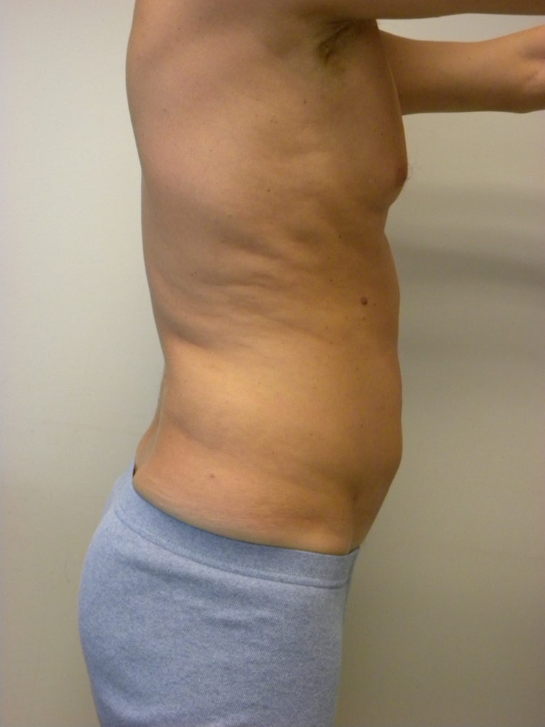 LIPOSUCTION BEFORE AND AFTER PICTURES IN MIAMI, FL