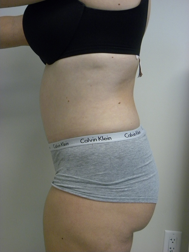 Tummy Tuck Before and After Pictures in Miami, FL