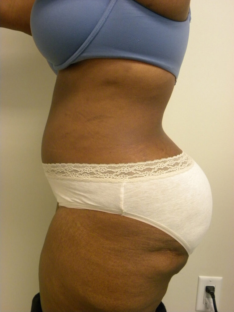 Tummy Tuck Before and After Pictures in Miami, FL