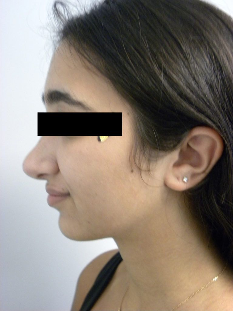 Rhinoplasty Before and After Pictures Miami, FL