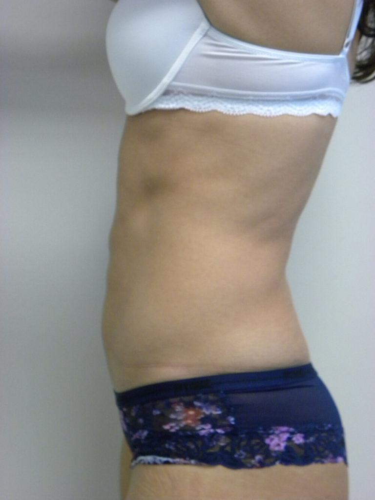 LIPOSUCTION BEFORE AND AFTER PICTURES IN MIAMI, FL