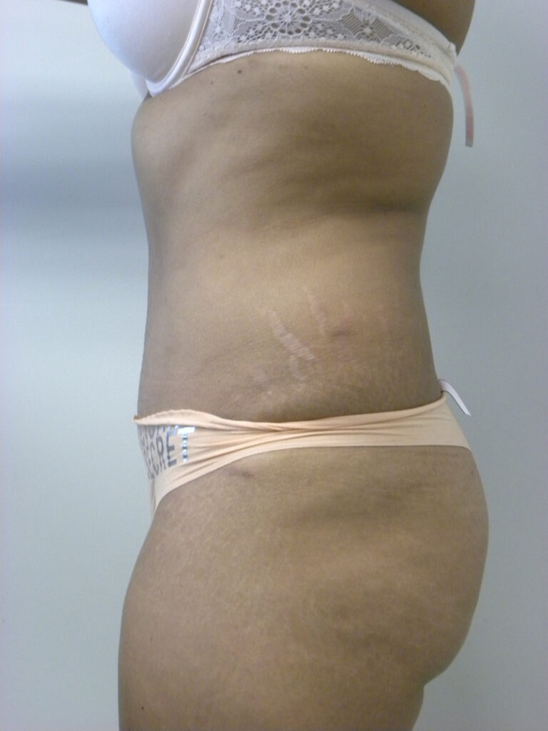 Tummy Tuck Before and After Pictures in Miami, FL