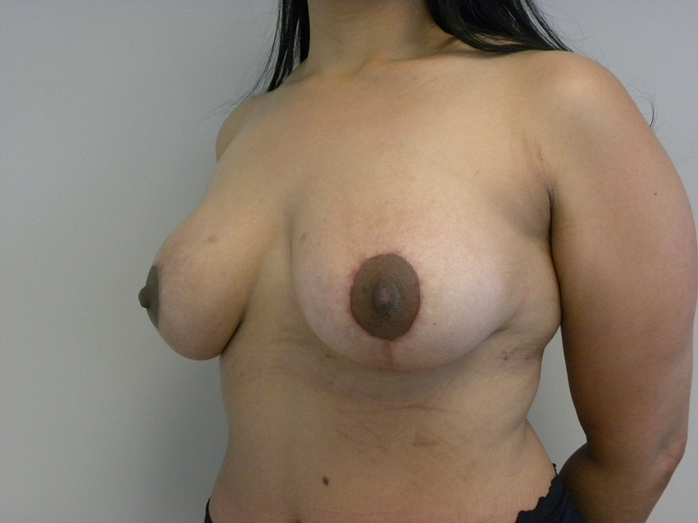 Breast Lift and Augmentation Before and After Pictures in Miami, FL