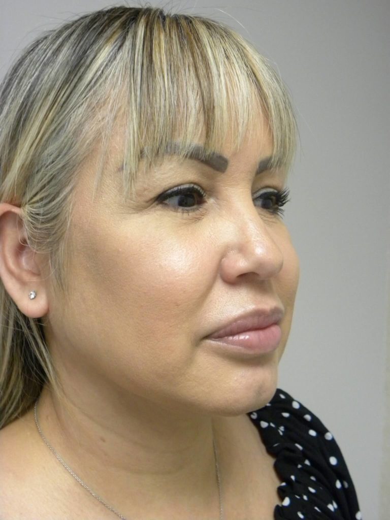 Neck Lift Before and After Pictures Miami, FL