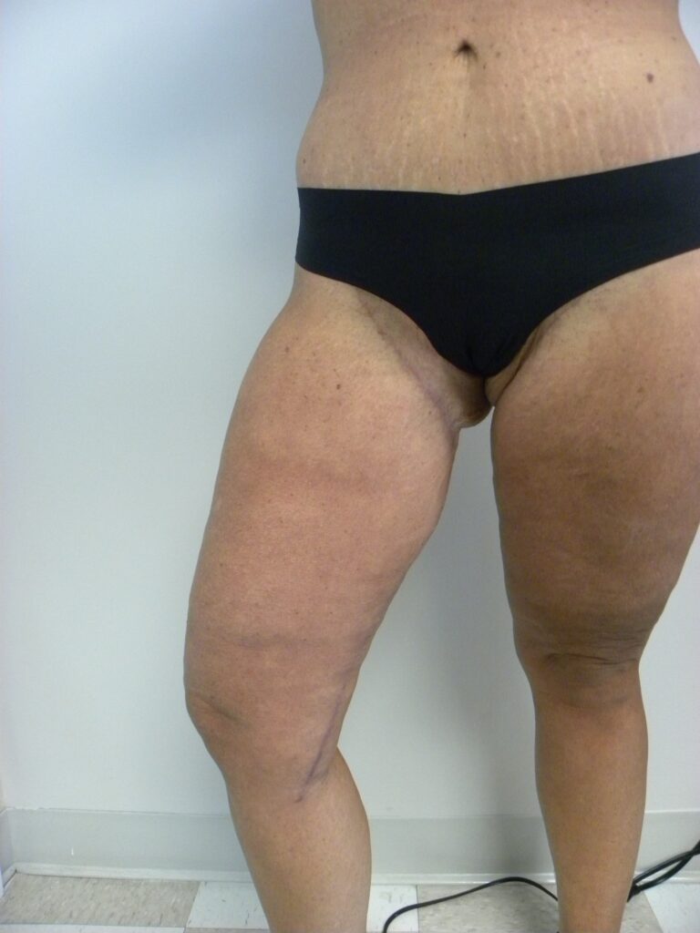 Thigh Lift Before and After Pictures in Miami, FL