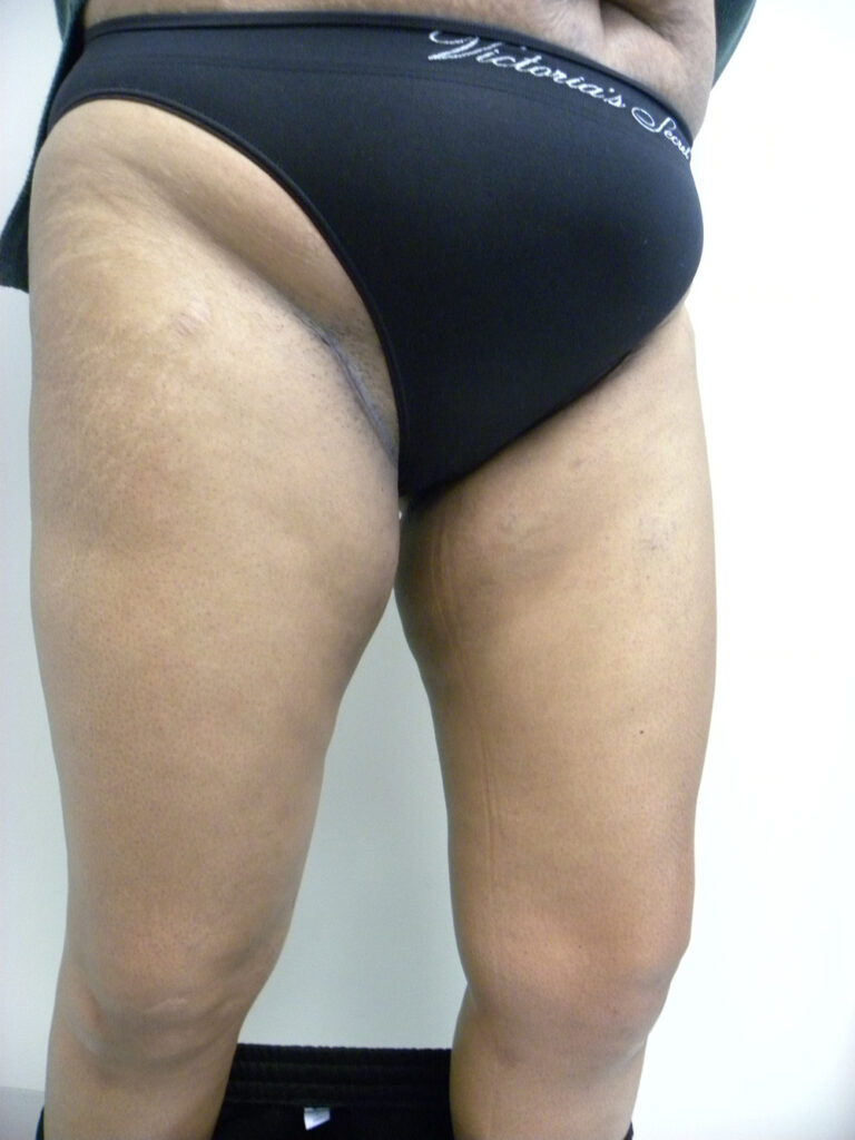 Thigh Lift Before and After Pictures in Miami, FL