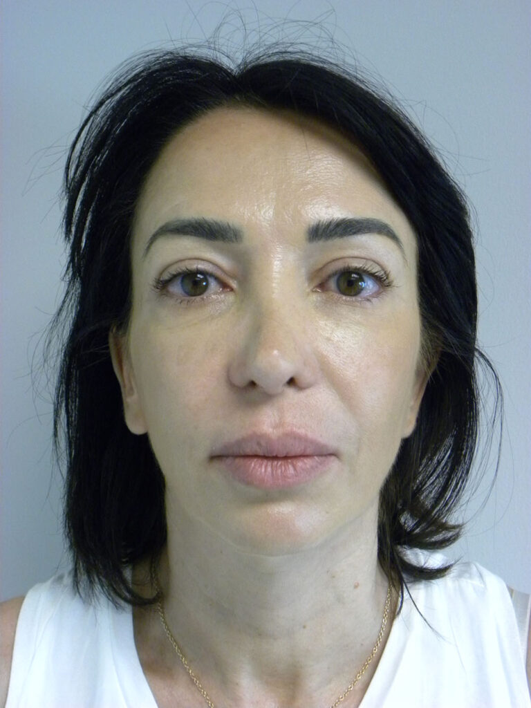 BLEPHAROPLASTY BEFORE AND AFTER PICTURES IN MIAMI, FL