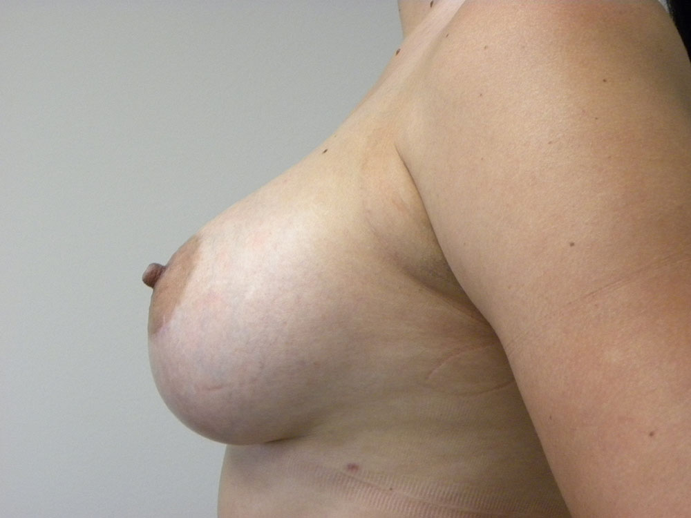 Plastic Surgery Before and After Pictures in Miami, FL - Dr. Adam J. Rubinstein 
