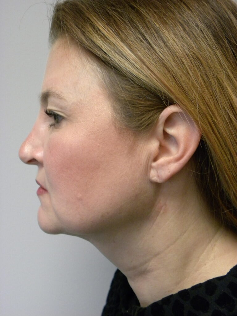 Minimally Invasive Neck Lift with Ellevate Before and After Pictures Miami, FL