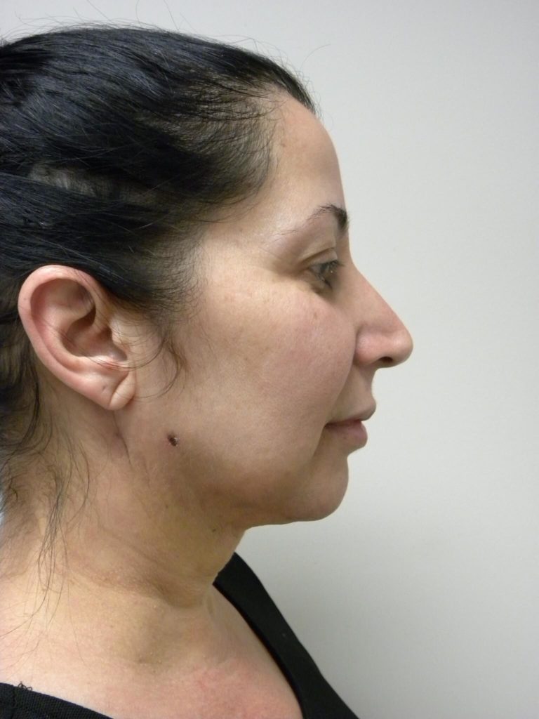 Minimally Invasive Neck Lift with Ellevate Before and After Pictures Miami, FL