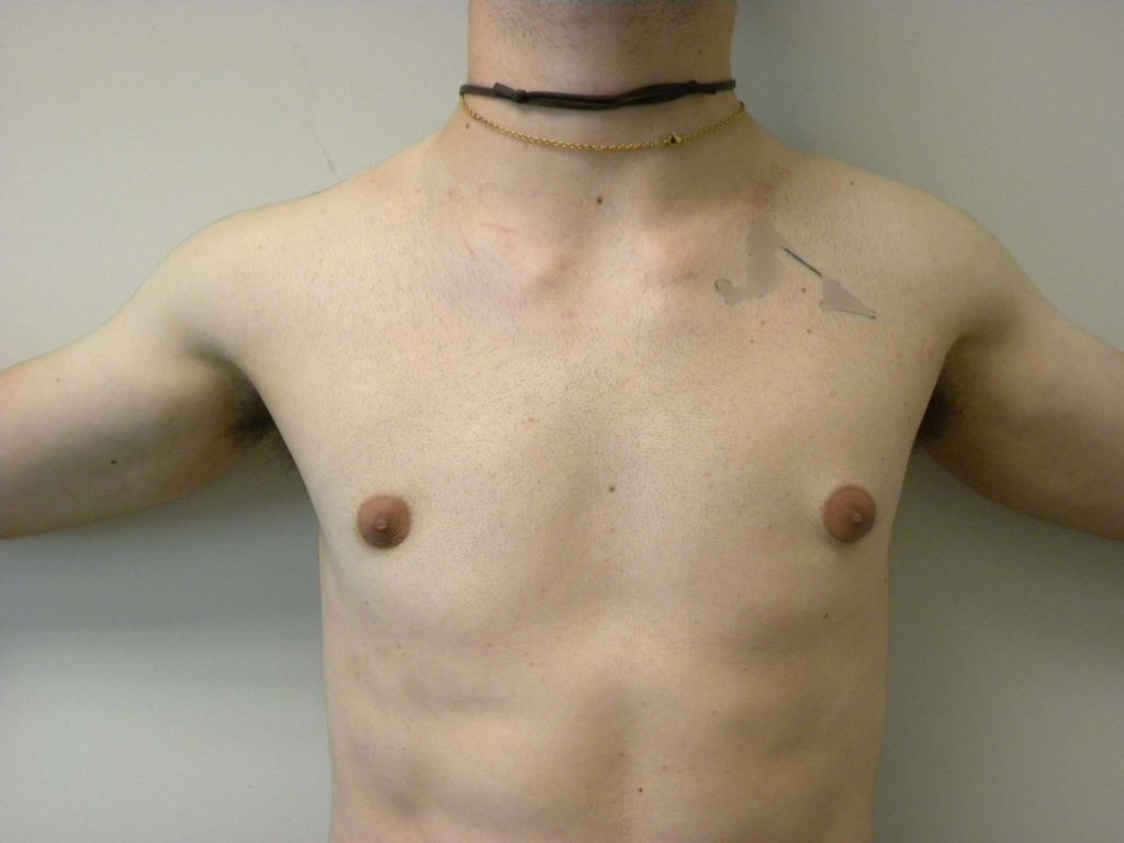 Gynecomastia Before and After Pictures in Miami, FL