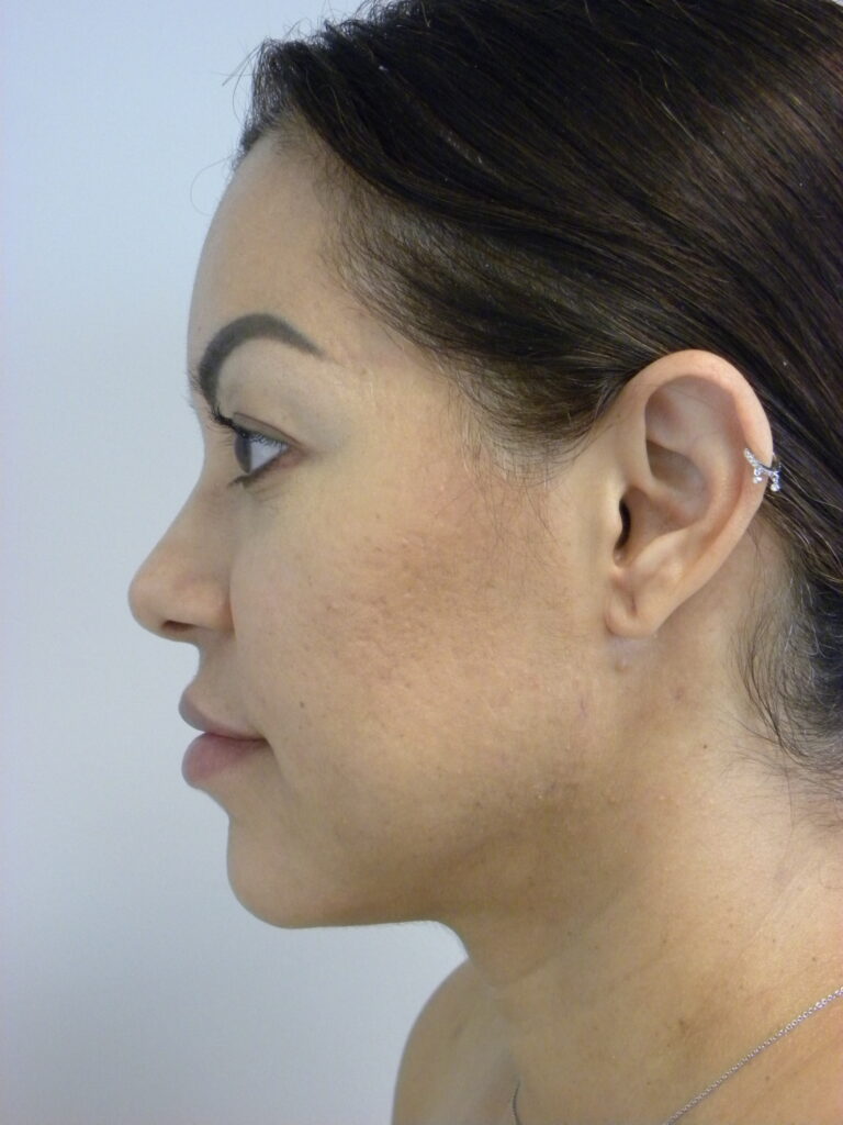 MINIMALLY INVASIVE NECK LIFT WITH ELLEVATE BEFORE AND AFTER PICTURES IN MIAMI, FL