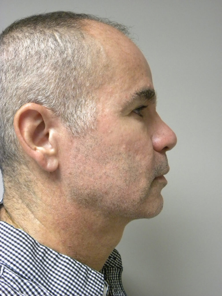 Male Neck Lift Before and After Pictures Miami, FL