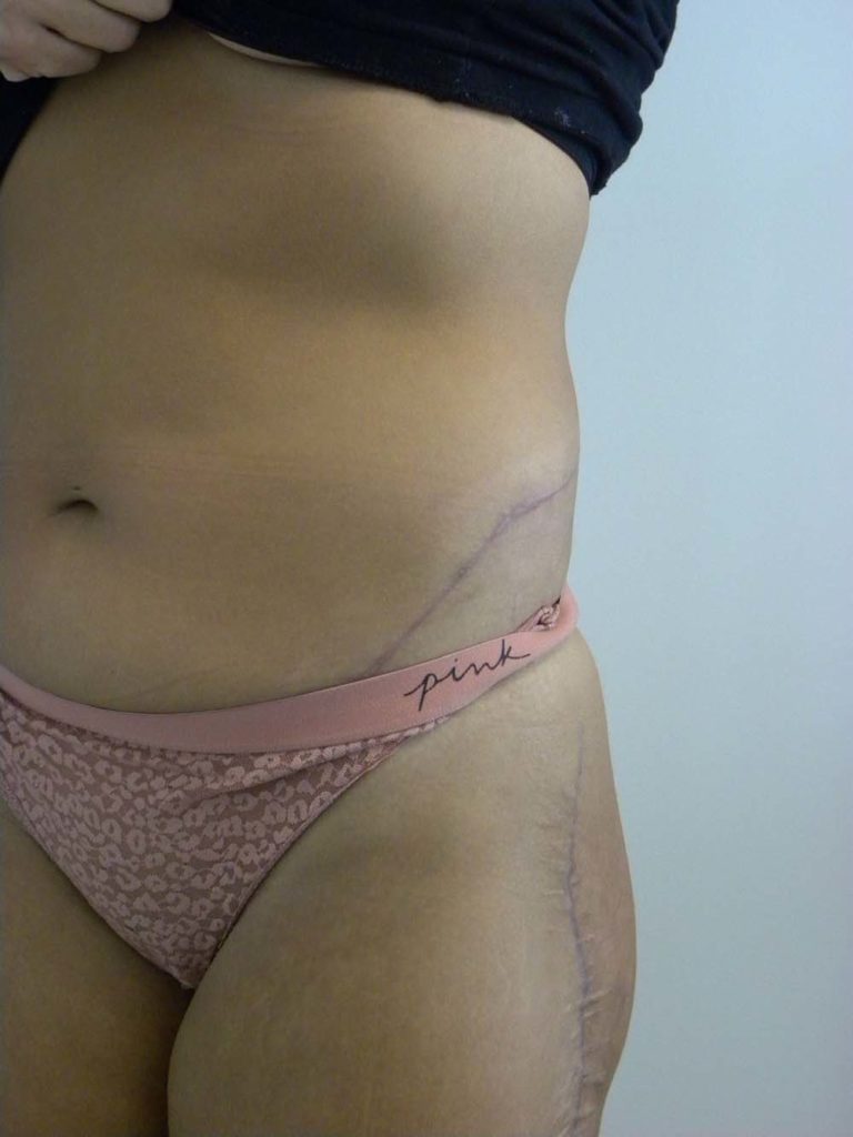 Scar Revision Before and After Pitcures in Miami, FL