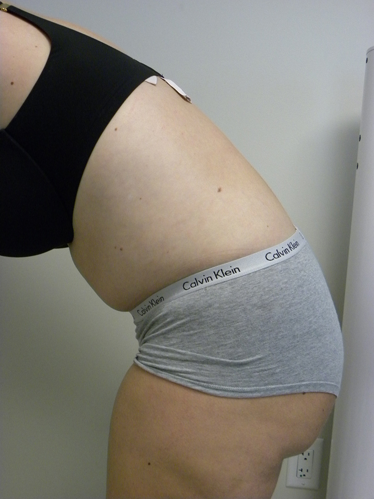 Tummy Tuck Before and After Pictures in Miami, FL