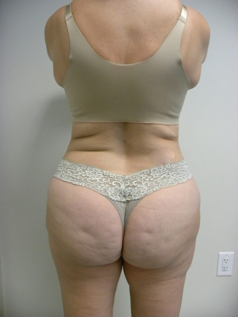 LIPOSUCTION BEFORE AND AFTER PICTURES IN MIAMI, FL