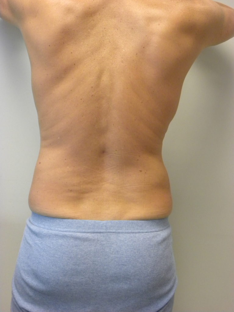 LIPOSUCTION BEFORE AND AFTER PICTURES IN MIAMI, FL