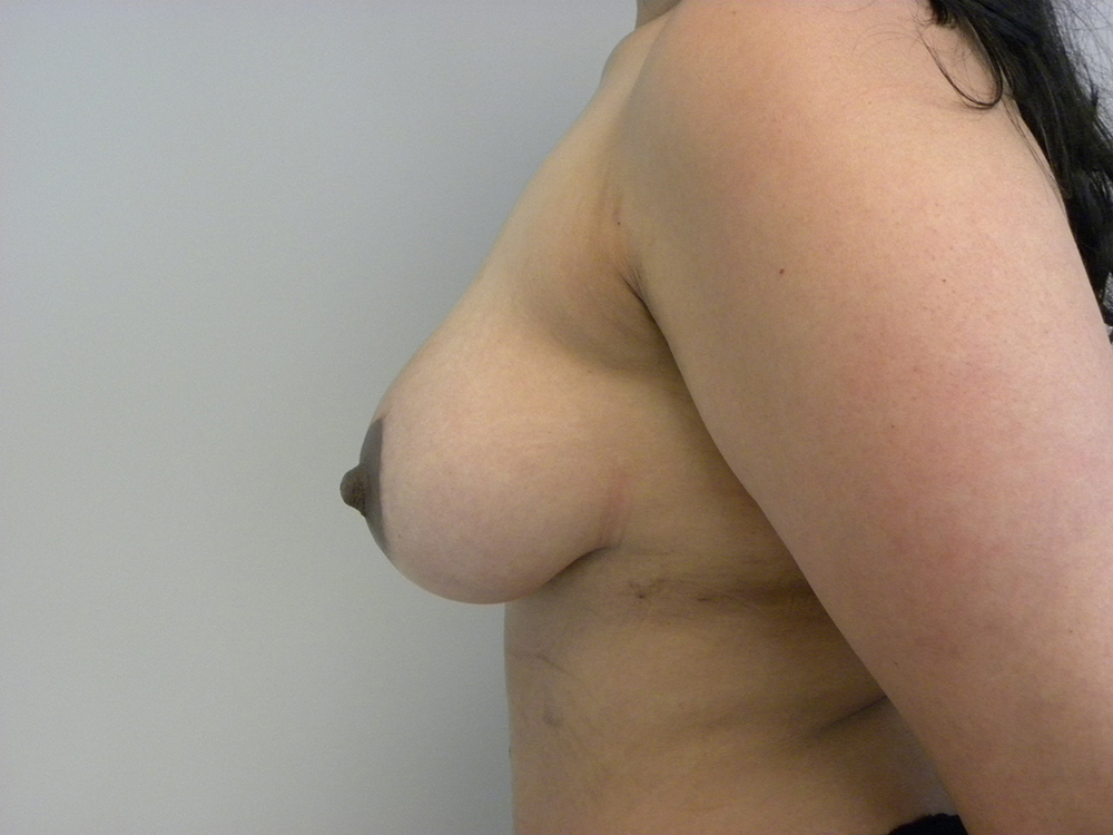 Breast Lift and Augmentation Before and After Pictures in Miami, FL