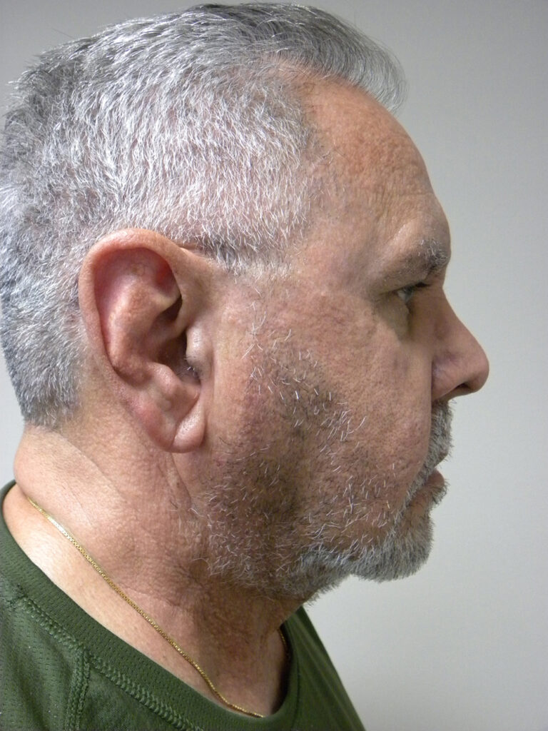 Neck Lift Before and After Pictures Miami, FL