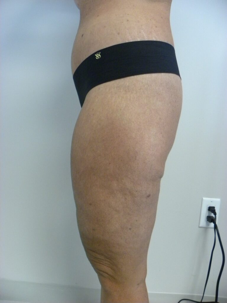 Thigh Lift Before and After Pictures in Miami, FL