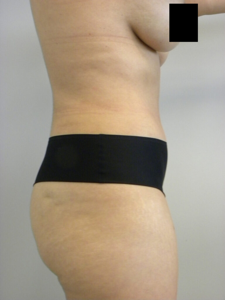 TUMMY TUCK BEFORE AND AFTER PICTURES IN MIAMI, FL