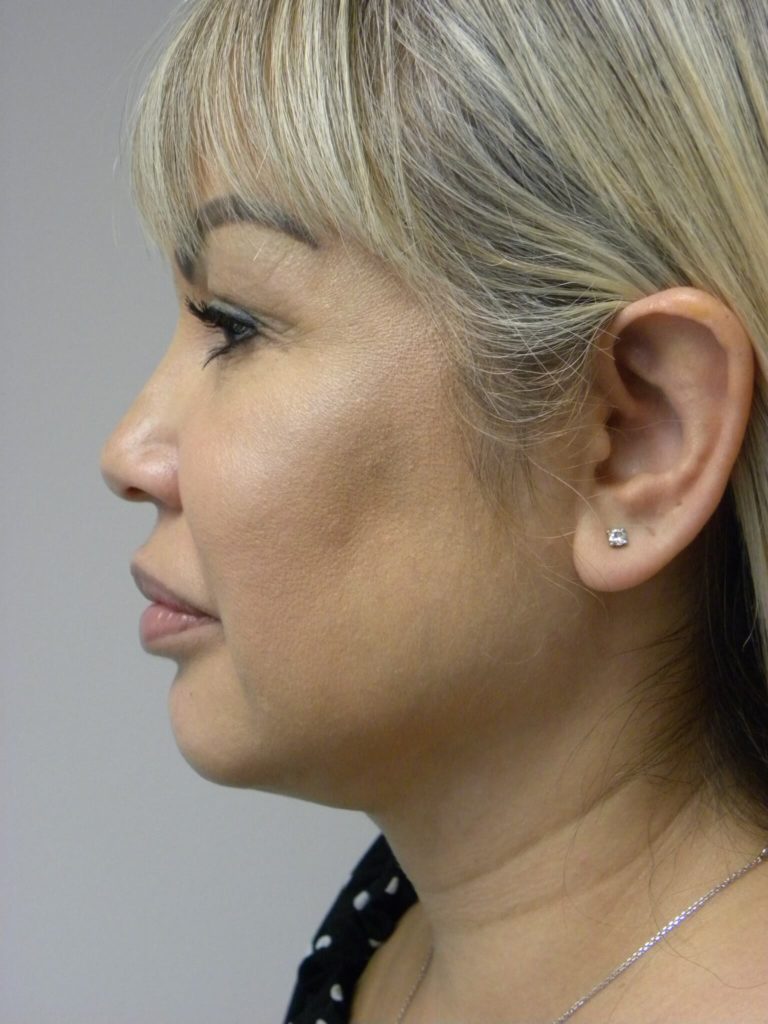 Neck Lift Before and After Pictures Miami, FL