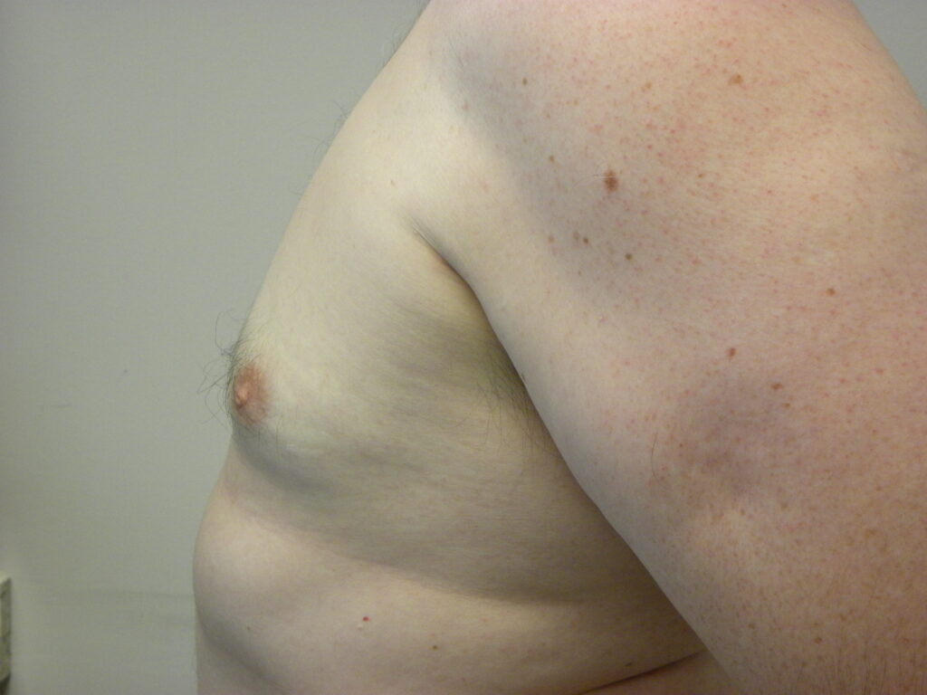 Plastic Surgery Before and After Pictures in Miami, FL - Dr. Adam J. Rubinstein 