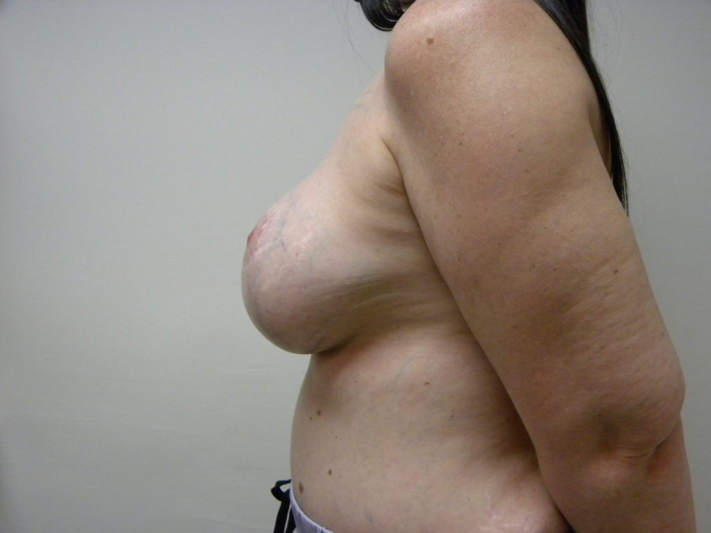 Revision Breast Augmentation Before and After Pictures Miami, FL