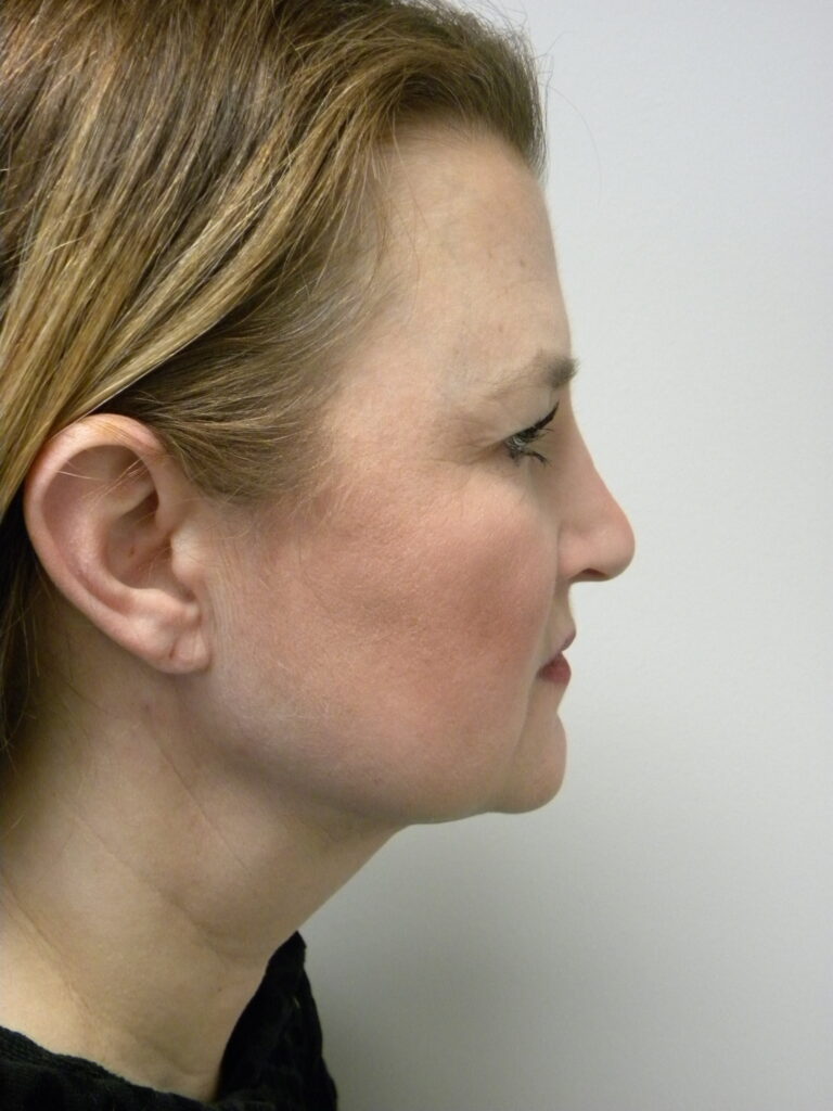 Minimally Invasive Neck Lift with Ellevate Before and After Pictures Miami, FL