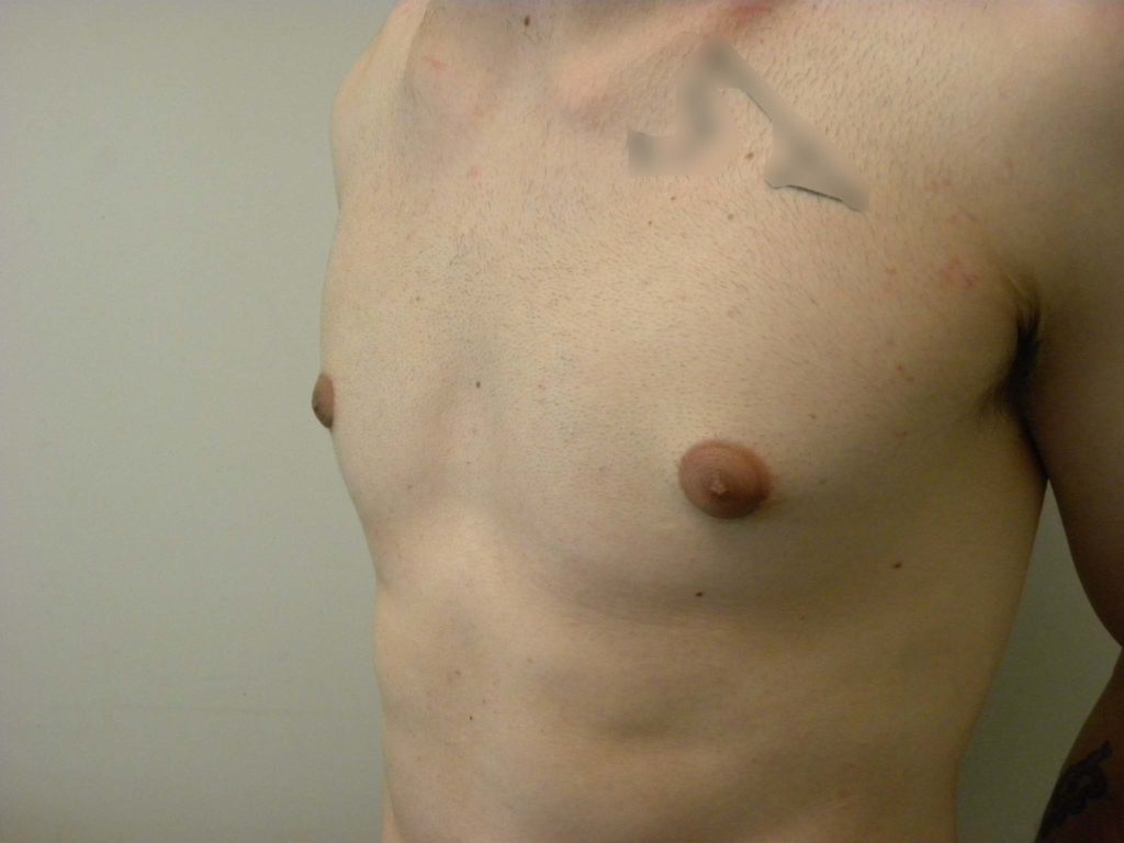 Gynecomastia Before and After Pictures in Miami, FL