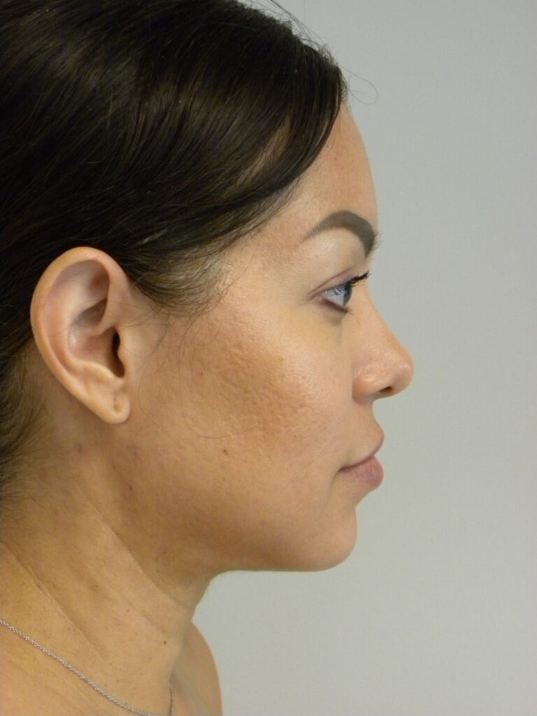 MINIMALLY INVASIVE NECK LIFT WITH ELLEVATE BEFORE AND AFTER PICTURES IN MIAMI, FL