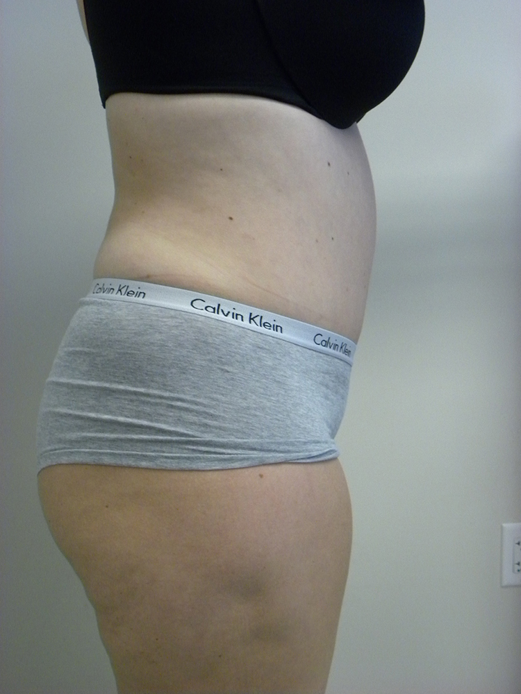 Tummy Tuck Before and After Pictures in Miami, FL