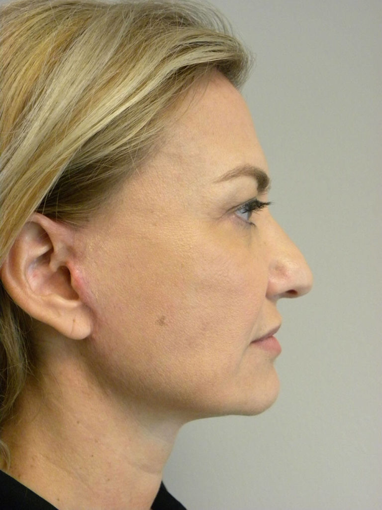 FACELIFT BEFORE AND AFTER PICTURES IN MIAMI, FL
