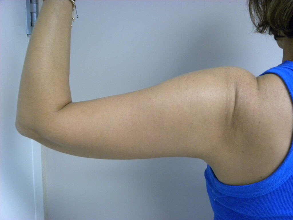 ARM LIFT BEFORE AND AFTER PICTURES IN MIAMI, FL