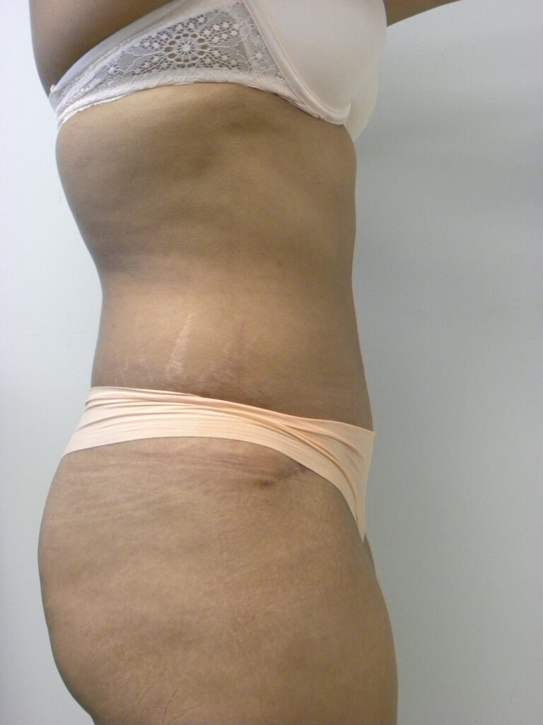 Tummy Tuck Before and After Pictures in Miami, FL