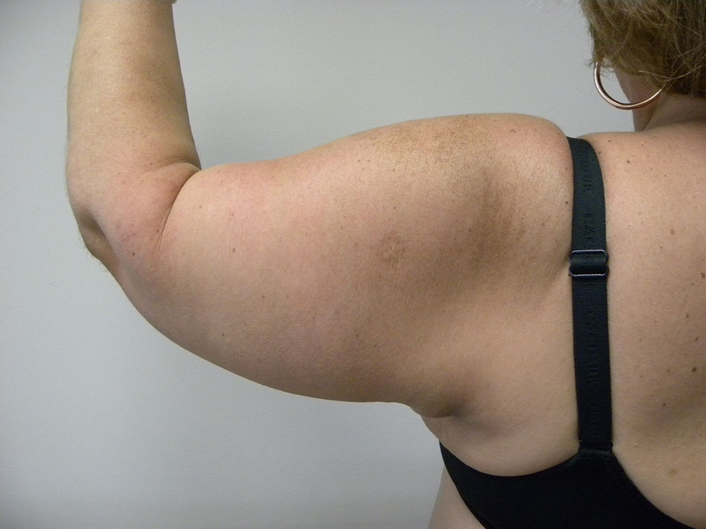 ARM LIFT BEFORE AND AFTER PICTURES IN MIAMI, FL