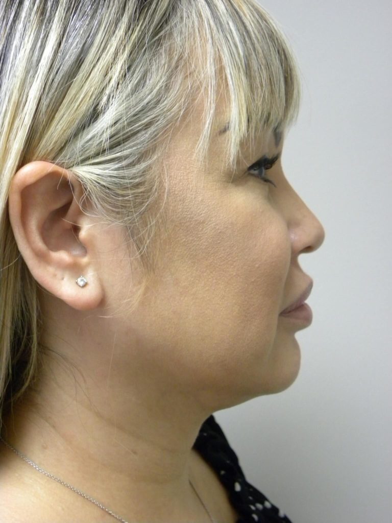 Minimally Invasive Neck Lift with Ellevate Before and After Pictures Miami, FL