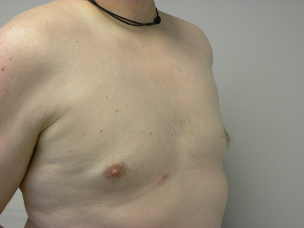 Plastic Surgery Before and After Pictures in Miami, FL - Dr. Adam J. Rubinstein 