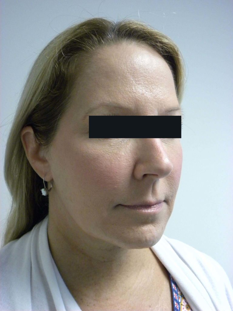 Neck Lift Before and After Pictures Miami, FL