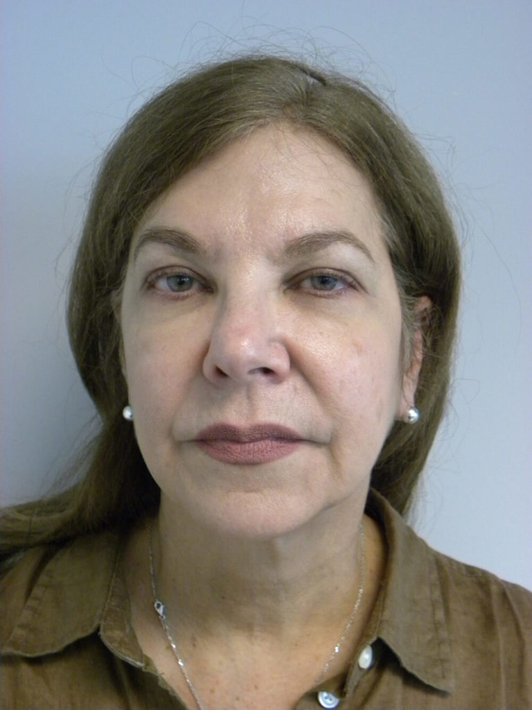 Neck Lift Before and After Pictures Miami, FL