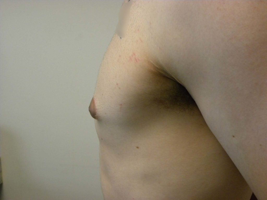 Gynecomastia Before and After Pictures in Miami, FL