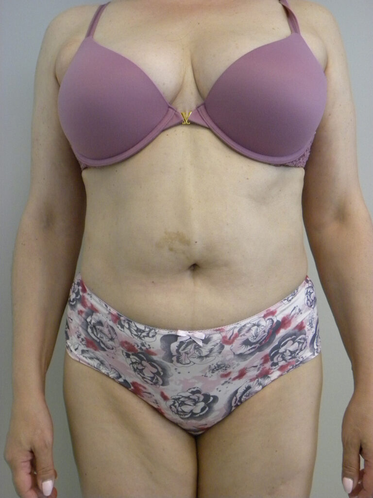 LIPOSUCTION BEFORE AND AFTER PICTURES IN MIAMI, FL