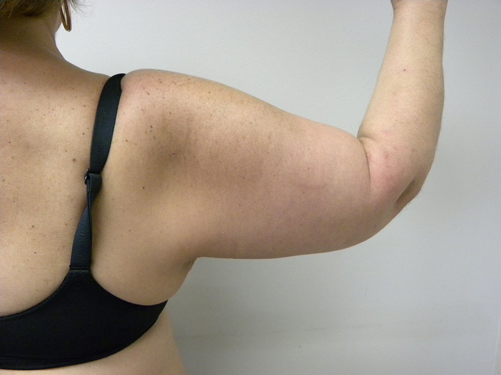 ARM LIFT BEFORE AND AFTER PICTURES IN MIAMI, FL