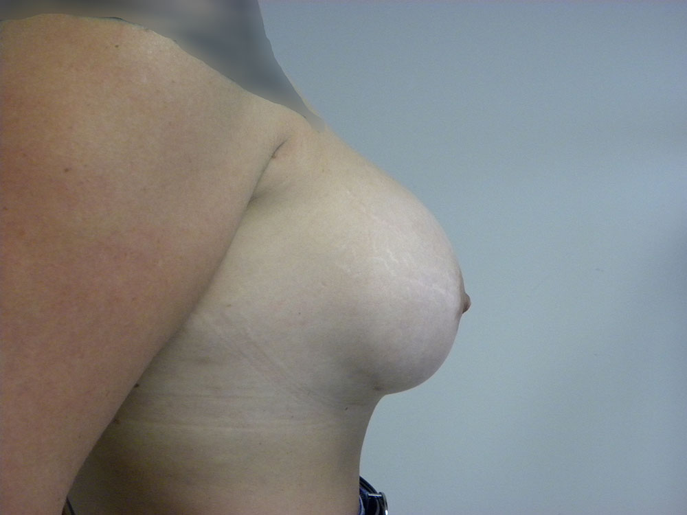 Revision Breast Augmentation Before and After Pictures in Miami, FL