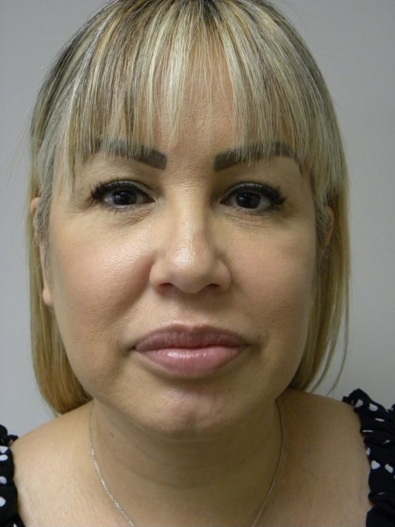 Neck Lift Before and After Pictures Miami, FL