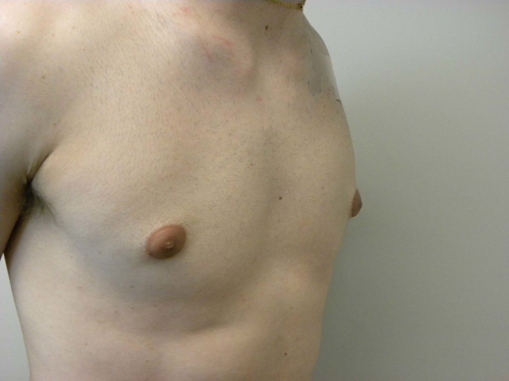 Gynecomastia Before and After Pictures in Miami, FL